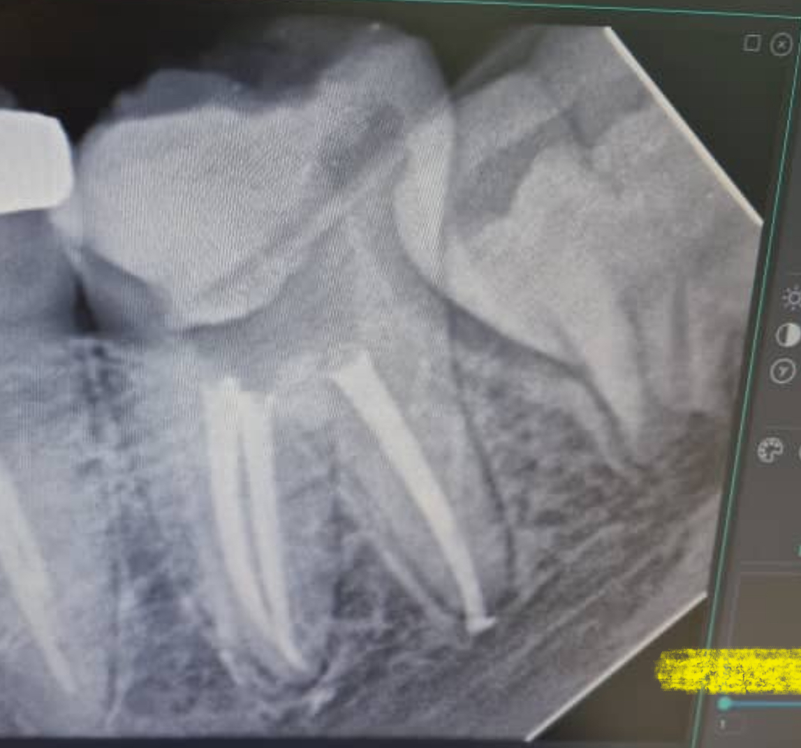 دکتر فرزین مازیار متخصص درمان ریشه  ( اندودانتیست )
