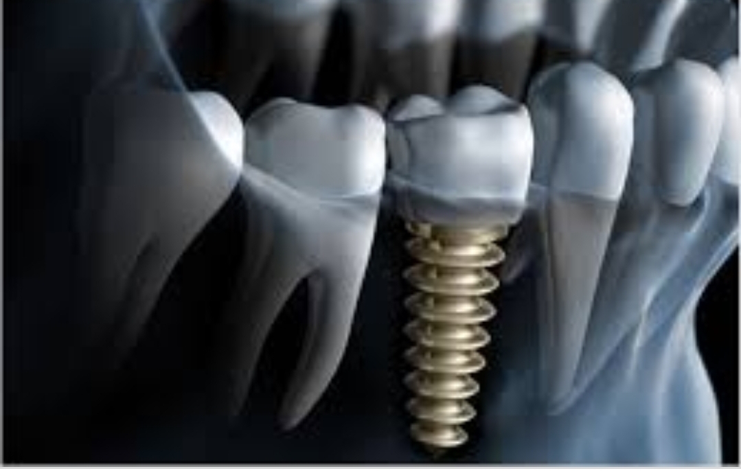 عصب کشی کنیم یا بکشیم ایمپلنت بزاریم ؟